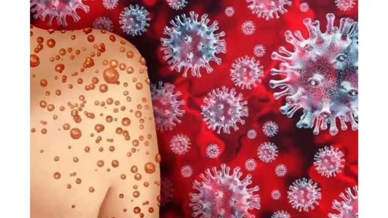 Mpox vs. COVID-19: Por Qué Son Enfermedades Distintas (Y Cómo Protegerte de Cada Una)