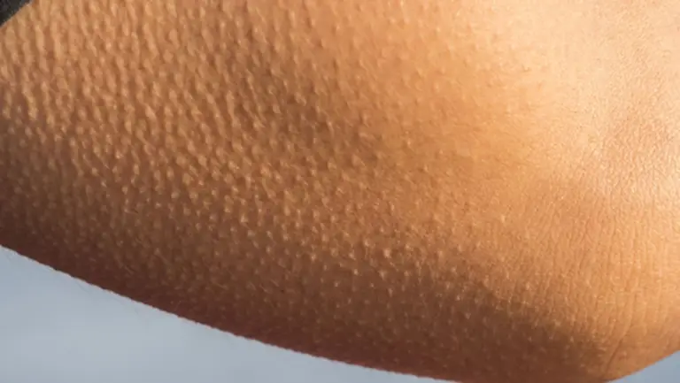 Mi hijo tenía la piel de gallina en los brazos, pensé que era alergia. La dermatóloga dijo otra cosa